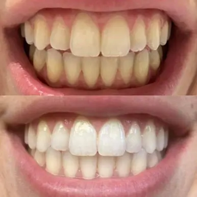 Gem Whitening Pen