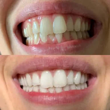 Gem Whitening Pen
