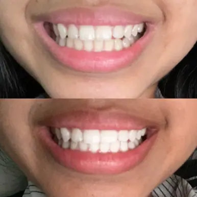 Gem Whitening Pen